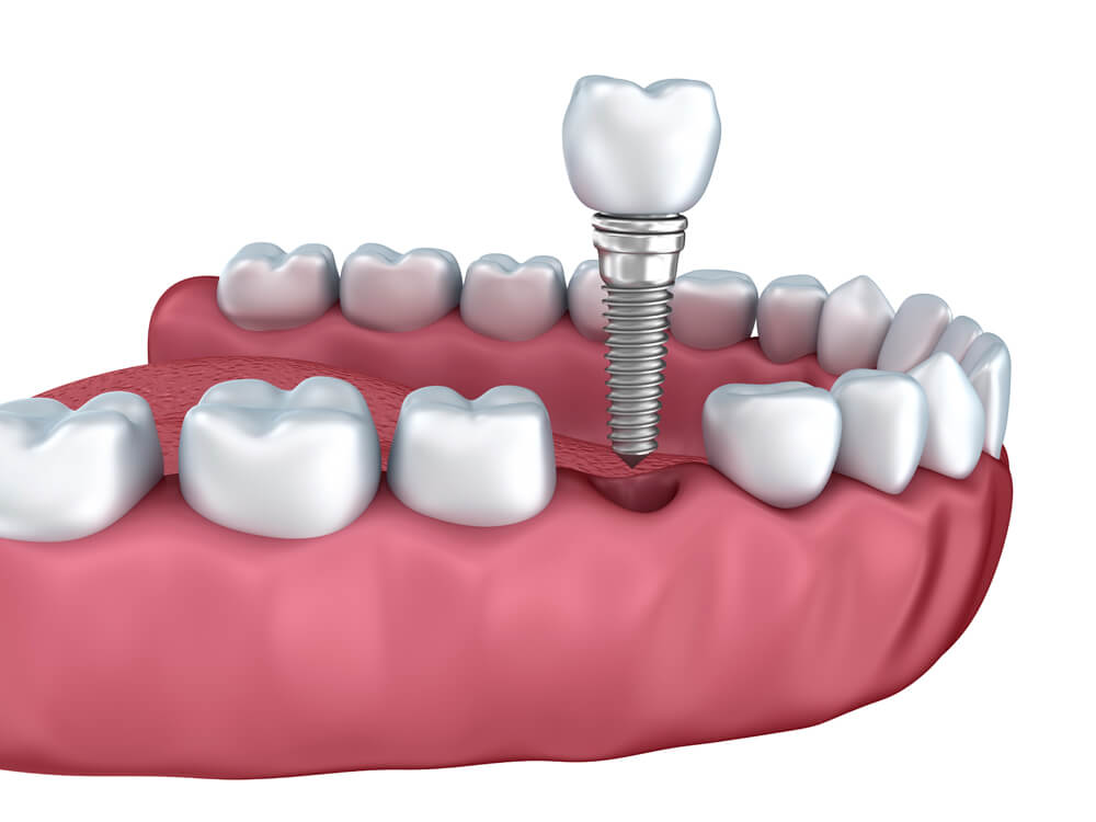 Implant zębowy - wprowadzanie Implant zęba cena Poznań