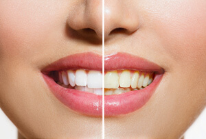 Wybielanie zębów w naszym gabinecie w Poznaniu - Smile Studio Efekty zabiegu wybielania zębów - Smile studio Poznań